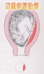 辺縁前置胎盤.jpg