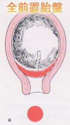 全前置胎盤.jpg